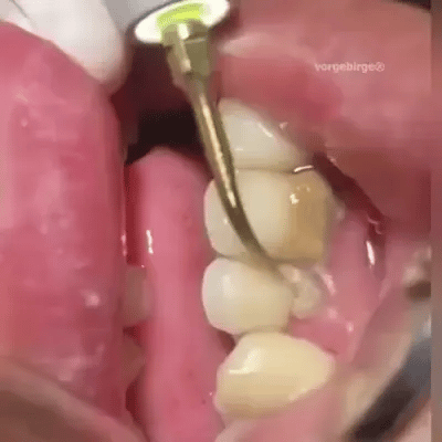 Limpieza Dental Ultrasónica Portátil